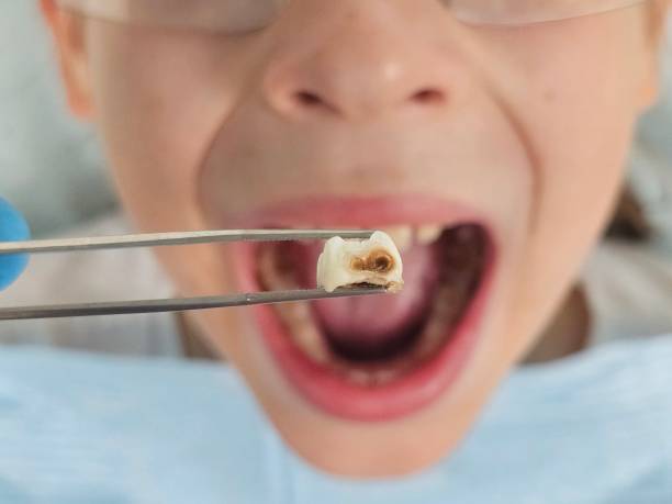 Best Tooth Infection Emergency Dentist  in Campbell, FL