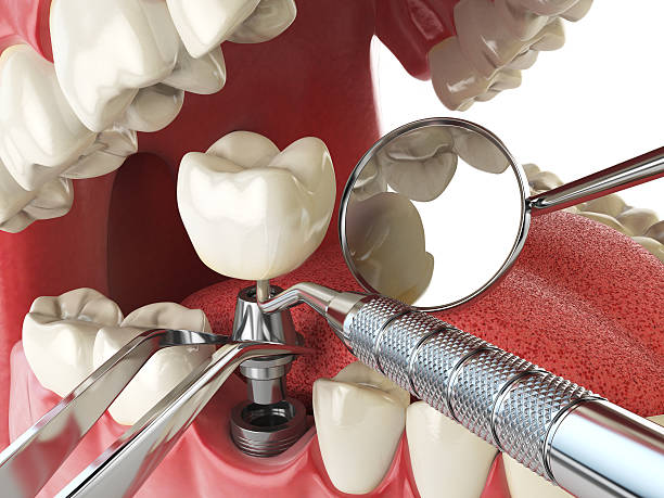 Tooth Infection Emergency Dentist in FL