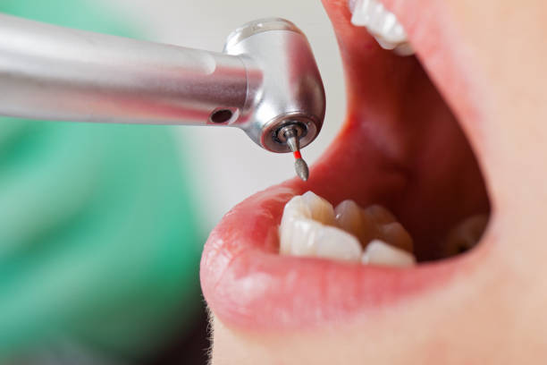 Best Chipped Tooth Repair Near Me  in Campbell, FL